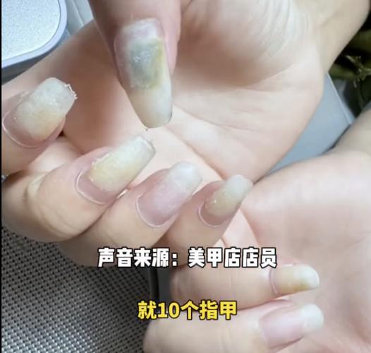 杭州女子频繁美甲,指甲惊现……医生:赶紧切!