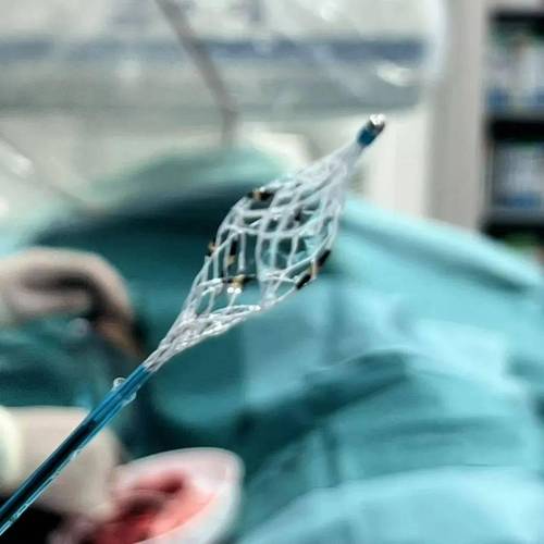 西南首例!采用Netrod系统的RDN手术在云南成功实施