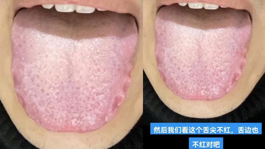 舌头上有齿痕,是湿气重吗?需要治疗吗?