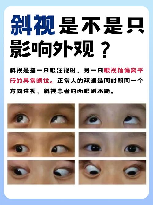 科普|间歇性外斜视——飘忽不定的眼睛
