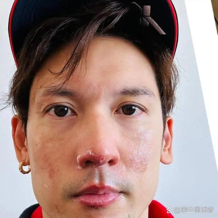 男演员突然自曝:煤气泄漏!脸被烧伤!