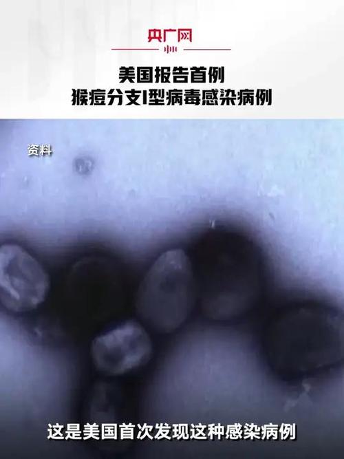 菲律宾活跃猴痘病例增至5例