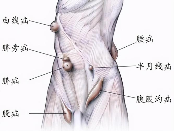 解析腹股沟疝